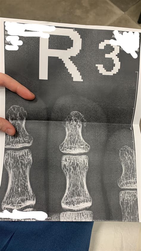 I fractured my toe today [OC] : r/pics