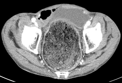 Ogilvie Syndrome Acute Colonic Pseudo Obstruction Early Recognition