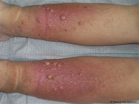 Chronic venous insufficiency from a dermatological perspective - Elena