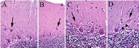 Purkinje Cell Heterotopias And Dendrite Swellings In Cerebellum From An