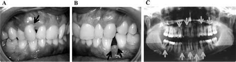 Clinical Aspect And Orthopantomograph Image Of A Representative Patient