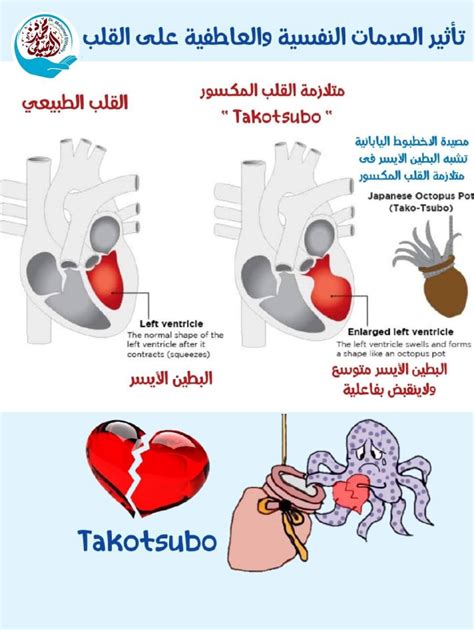 عيادة الجمعة ومتلازمة كسرة القلب مجرد لمبة