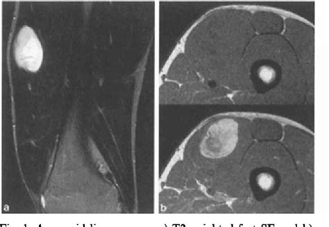 Figure 1 From Mr Imaging Of Lipoma And Liposarcoma Semantic Scholar