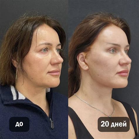 Подтяжка лица | Круговая подтяжка лица в Москве - Цены