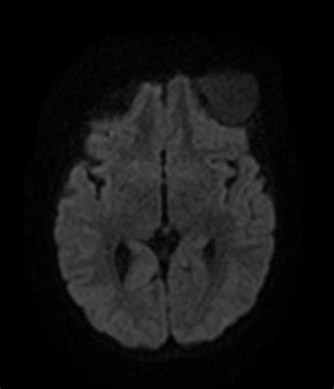 Intradiploic White Epidermoid Cyst Image Radiopaedia Org