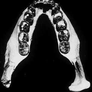 The Taung child. This fossil was described in 1925 by Raymond Dart, who ...