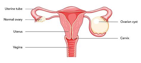 Ovarian Endometriomas Chocolate Cysts Female Reproductive System Uterus