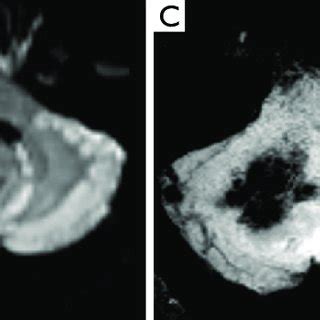 Male, 6 years old, diagnosis of pilocytic astrocytoma KIAA1549-BRAF ...