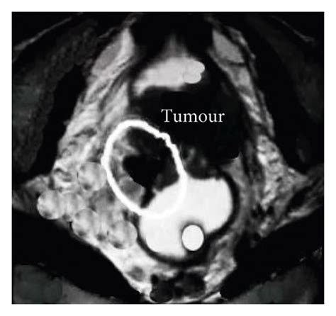 MRI images of a patient with rectal cancer. In Figure 3, arrows and... | Download Scientific Diagram