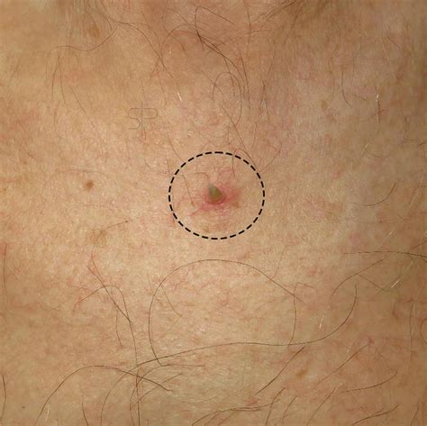 Cutaneous Horn What It Is Why It Forms And How To Treat It