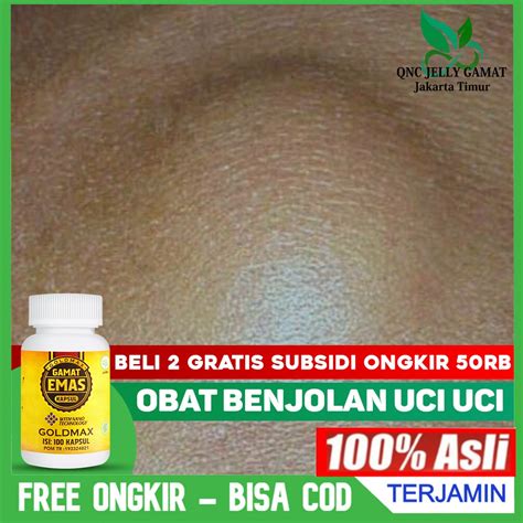 Jual Obat Benjolan Uci Uci Kista Ganglion Benjolan Di Tangan