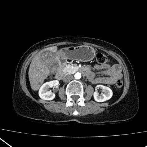 Gallbladder Carcinoma Image Radiopaedia Org