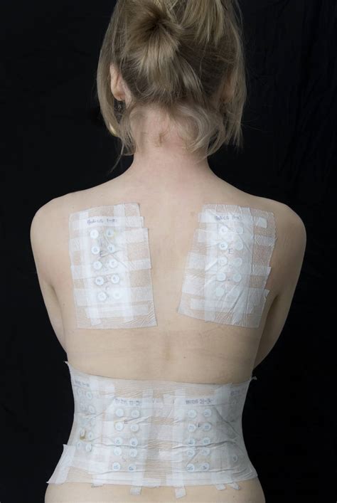 Allergy Patch Testing Los Angeles - Allergic Contact Dermatitis Test