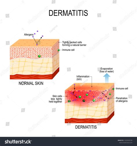 Atopic Dermatitis Atopic Eczema Healthy Skin Stock Illustration 1222939159