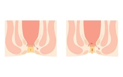 Anatomia Anal Fissure Images Stock Photos D Objects Vectors Shutterstock