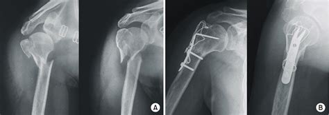 Figure From The Treatement Of The Unstable Proximal Humerus Fracture