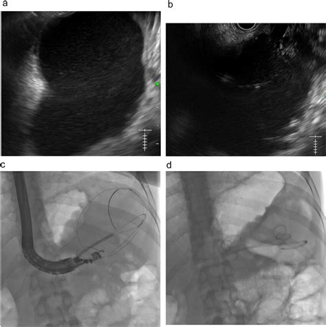 Eus Guided Transmural Drainage With Multiple Plastic Stents A Eus
