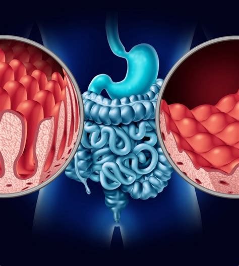 celiac disease food safety blog food safety resources tips