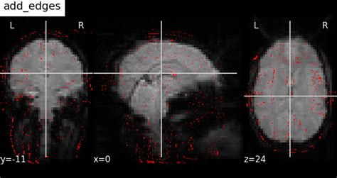 Plotting Brain Images Nilearn