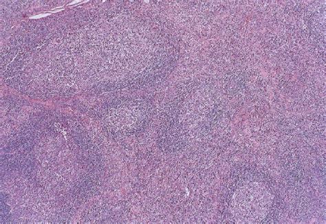 Nodular Thymic Lymphoid Follicular Hyperplasia Mimicking Thymoma