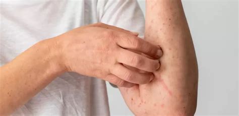 Dermatitis Atopik Penyebab Gejala Dan Cara Menanganinya Surat Dokter