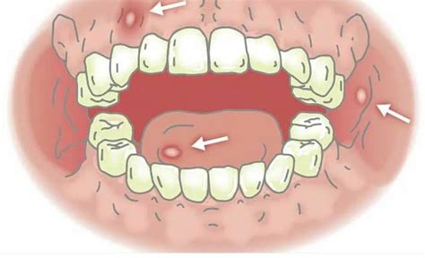 Стоматит больше не беспокоит | Пикабу