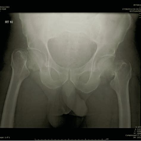 Radiograph Of The Pelvis Showing Bilateral Hip Fractures Before The