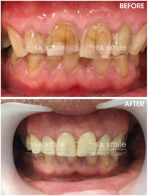 The Advantages And Disadvantages Of Oral Veneers