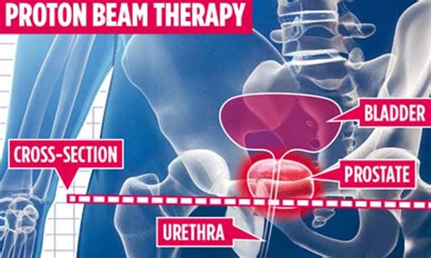 Prostate Cancer Breakthrough To Save Your Sex Life Daily Mail Online