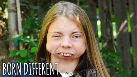 I Was Born Without A Jaw Born Different