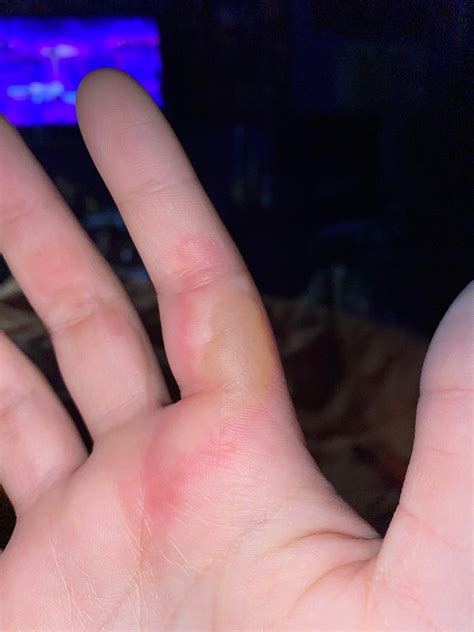 Progress Of My Second Degree Burn Blisters Rmedicalgore