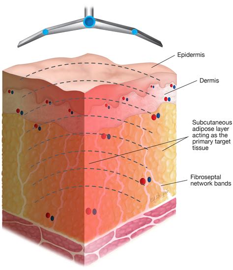 Introduction And Overview Of Radiofrequency Treatments In Aesthetic