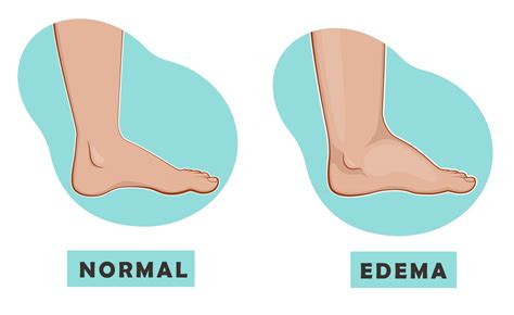 A Swollen Foot And Ankle And A Normal Foot Vector Illustration Of The