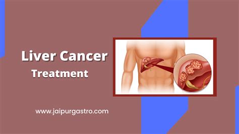 Liver Cancer Treatment