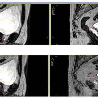 Daily Interfraction Variability Of Planning Target Volume PTV And