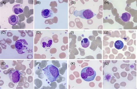 Reactive Neutrophil