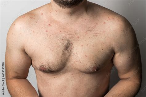 Naked Man With Red Pimples On His Chest Acne Skin Disease Dermatology Problem Stock Photo