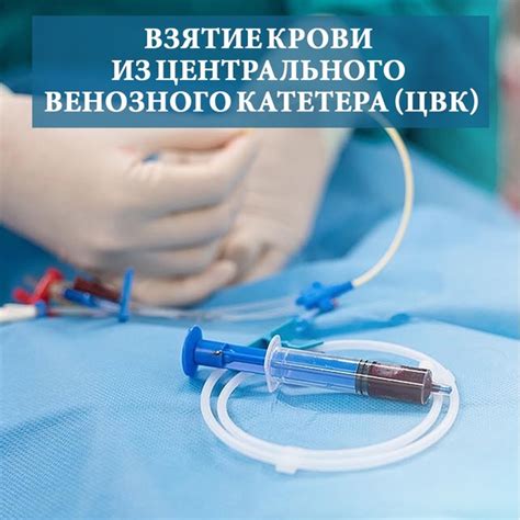 Центральный венозный катетер (ЦВК) – это медицинское устройство ...