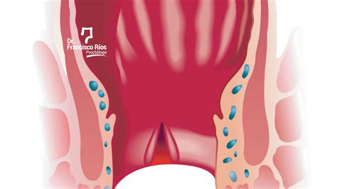 Qué es una Fístula Anal Dr Francisco Ríos