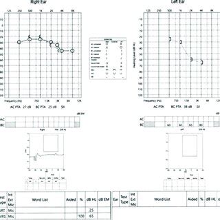 Audiogram showing sensorineural hearing loss of the right ear decreased... | Download Scientific ...