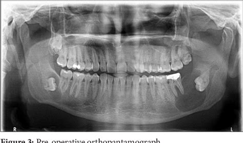 Figure 1 From Bilateral Dentigerous Cyst A Case Report Semantic Scholar