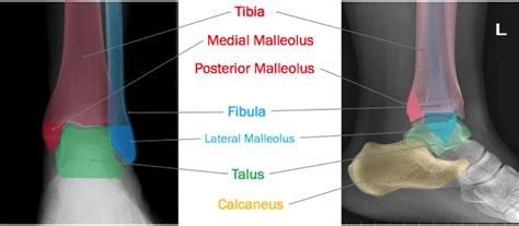 Medial Malleolus Of Tibia