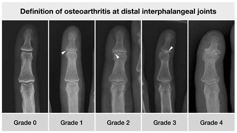 Osteo Proliferative Lesions Of The Phalanges On Radiography Associations With Sex Age And