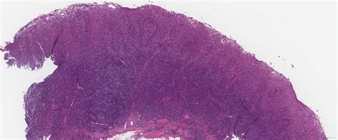 Treponema infection of the oropharynx | Ottawa Atlas of Pathology