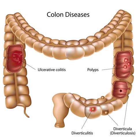 What Can Cause Bloody Stool in Children? (with pictures)