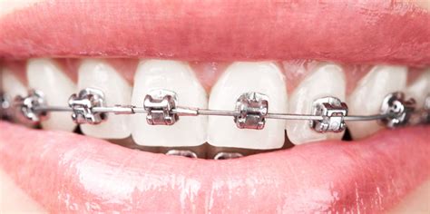 types of braces for adults teeth