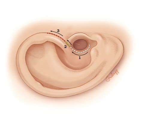 Fundamentals Of Ear Surgery Oto Surgery Atlas