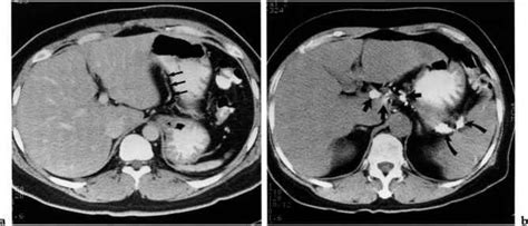 gastrohepatic ligament  hepatoduodenal ligament dynamic radiology