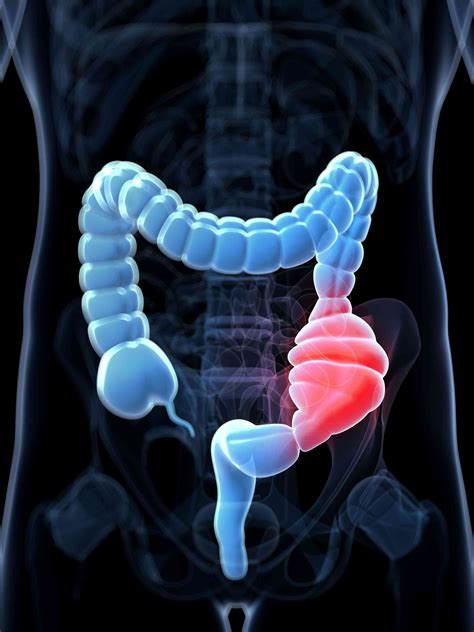 Constipation, straining can cause painful anal fissure - The Zimbabwe