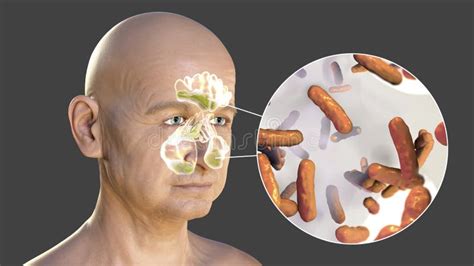 Purulent Inflammation Of Right Frontal Sinus In A Man And Close Up View